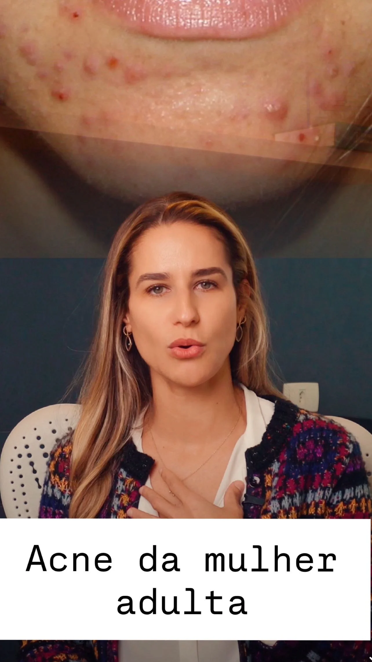 Acne na mulher adulta