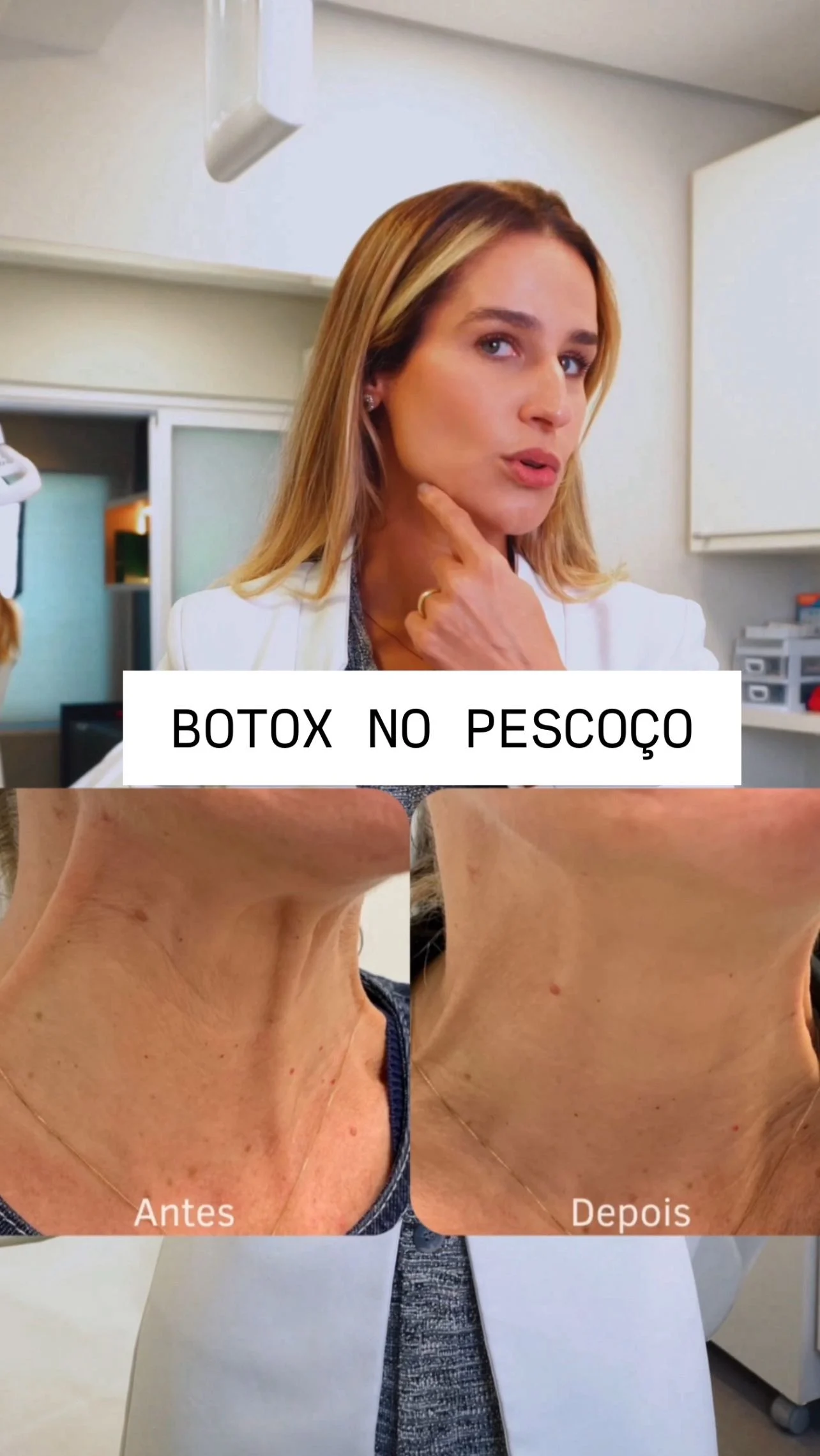 Botox no pescoço: os pontos de Nefertiti