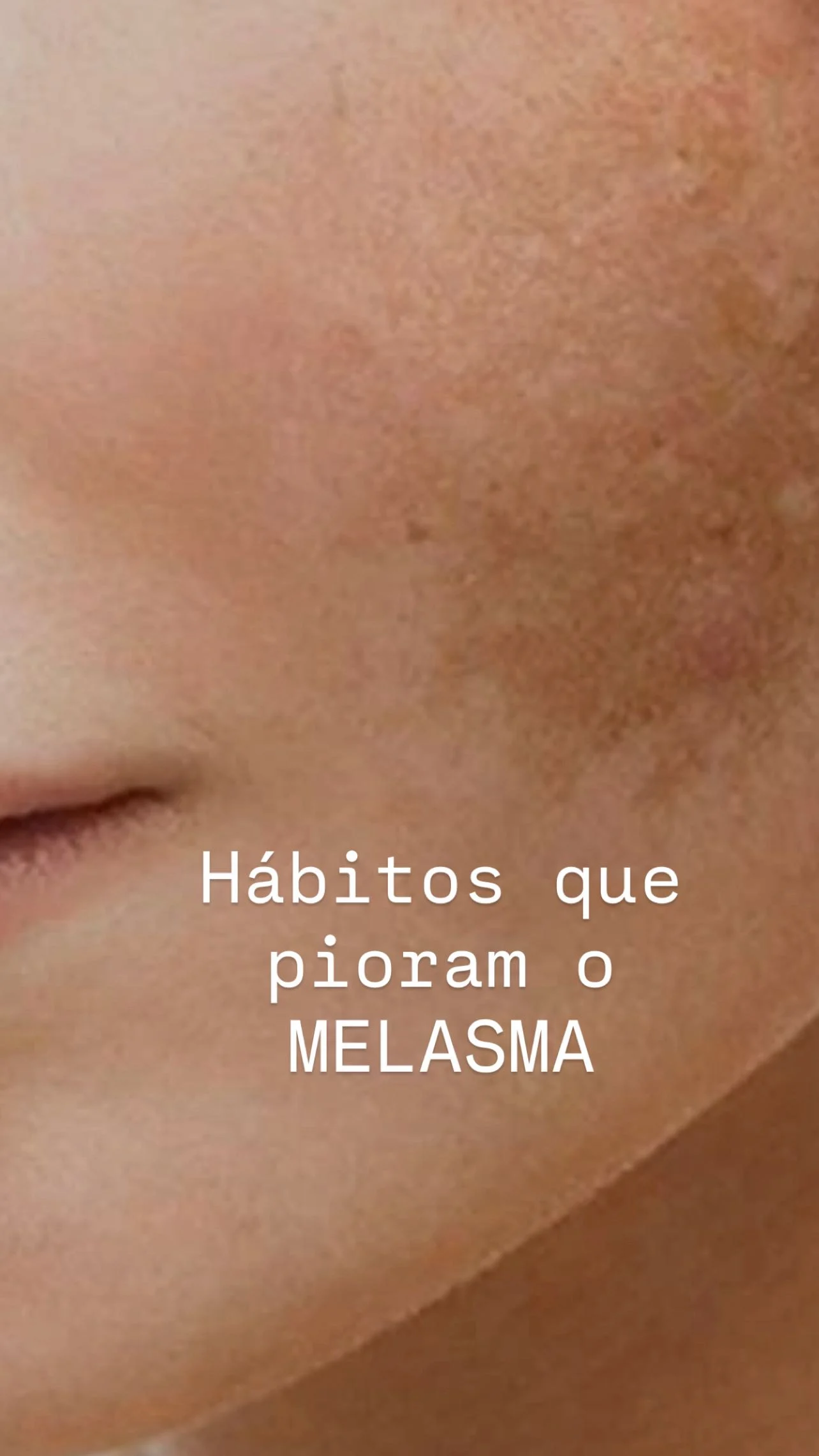 Hábitos que atrapalham o controle do melasma