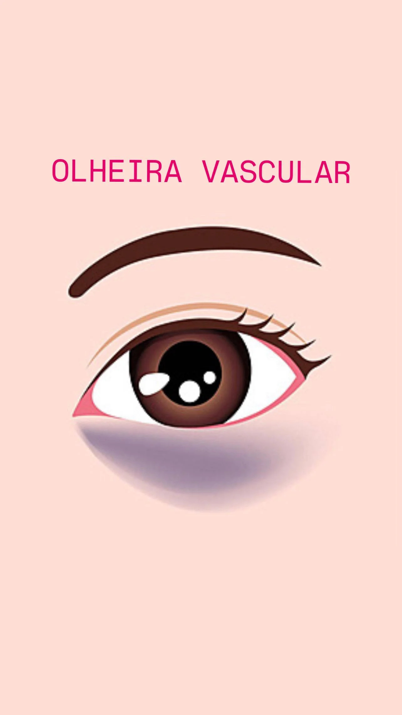 Olheira vascular (arroxeada): como tratar