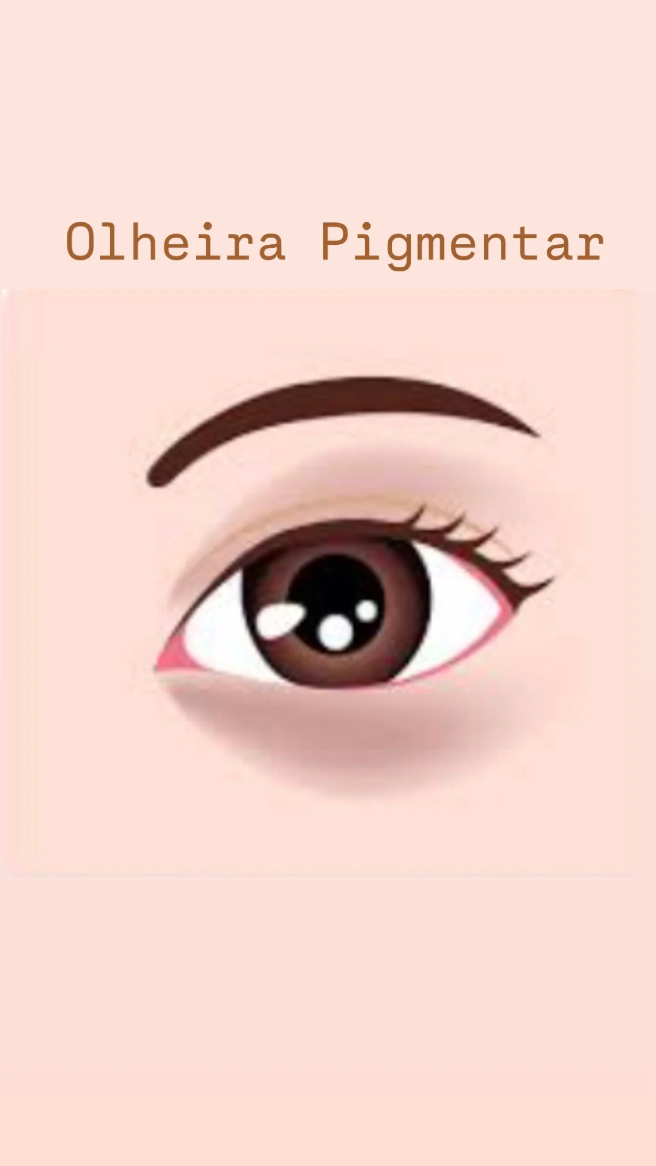 Olheira acastanhada (pigmentar): como tratar
