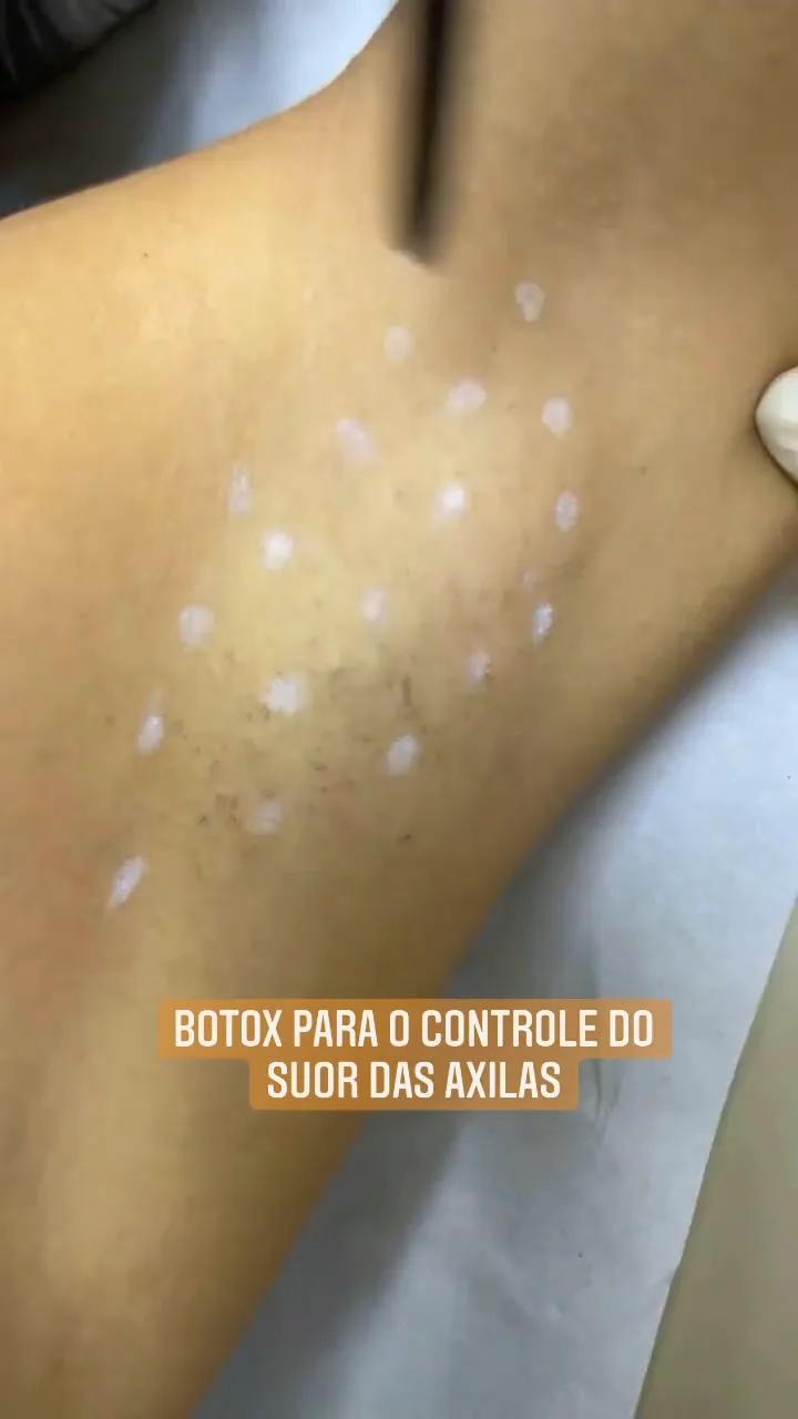 Botox para o controle do suor nas axilas