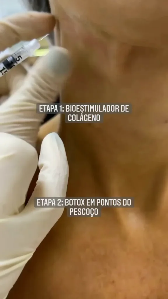 Pescoço em duas etapas: bioestimulador e botox