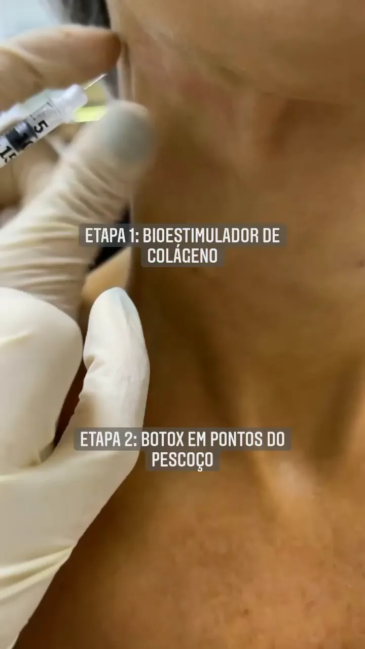 Pescoço em duas etapas: bioestimulador e botox