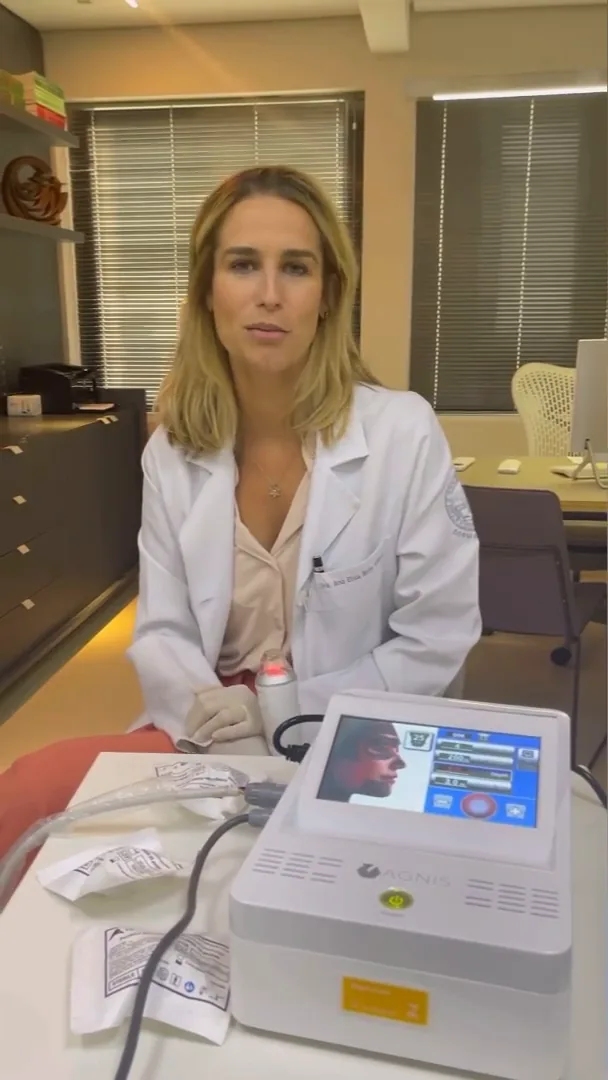 Radiofrequência microagulhada no tratamento das estrias