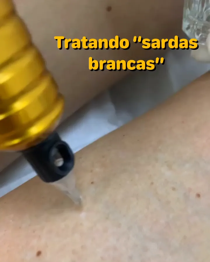 MMP: microinfusão de medicamentos na pele
