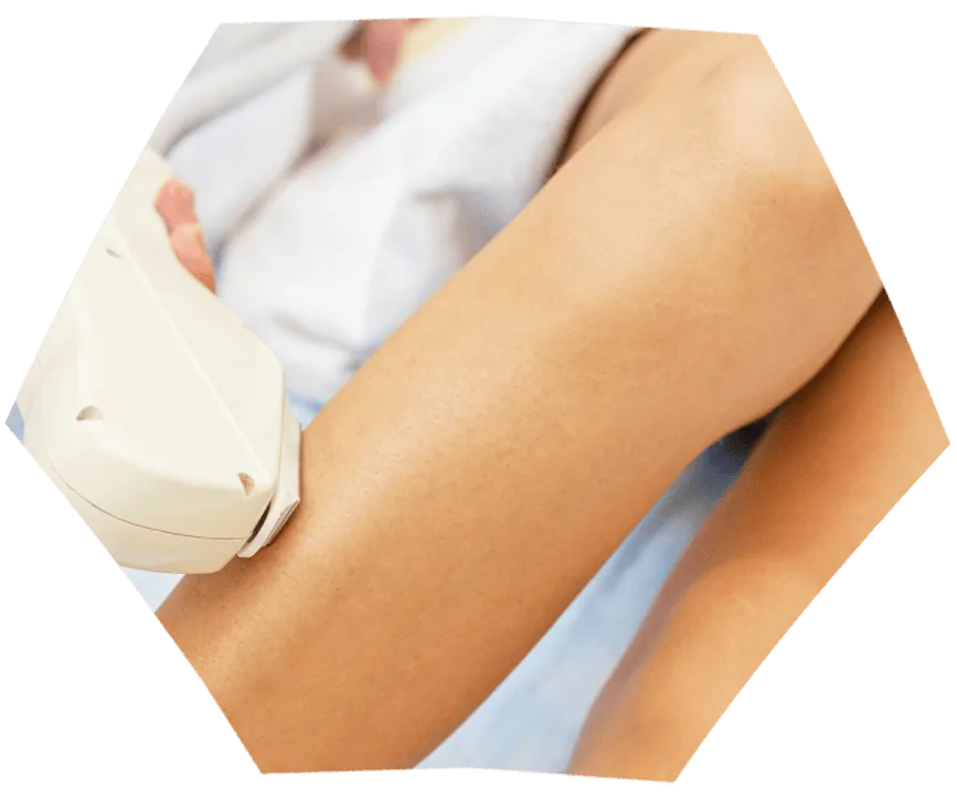 Depilação a laser — tratamento com a Dra. Ana Elisa Brito Vilibor, dermatologista